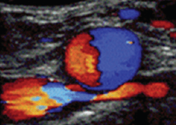 Figure 3 Compressed Color Doppler.png